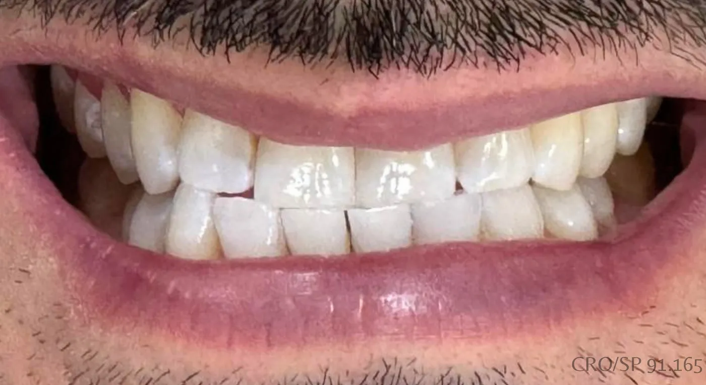 Depois do tratamento — Clareamento dentário. Valorização da estética do sorriso.