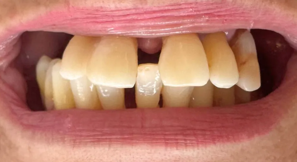 Antes do tratamento — Protocolo — prótese fixa sobre implantes. Reabilitação de arcada completa.