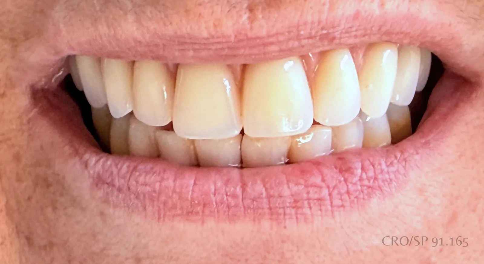 Depois do tratamento — Protocolo — prótese fixa sobre implantes
